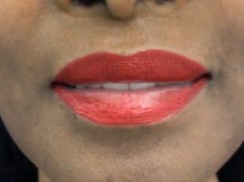 Natural lip lift result by Dr. Ricardo L. Rodriguez, Baltimore.