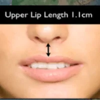 Upper lip length 1.1 cm.