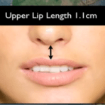 An illustration of an upper lip length 1.1cm.