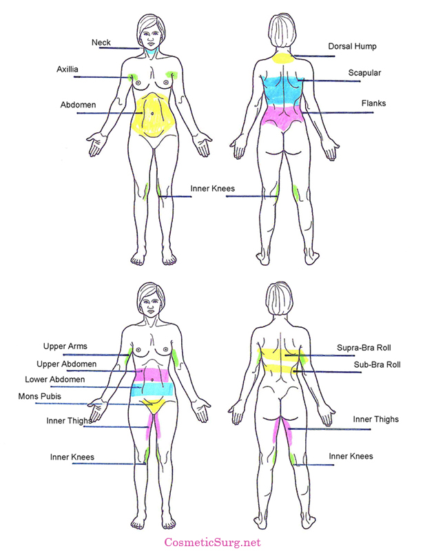 Diagram of the female body detailing common liposuction areas.