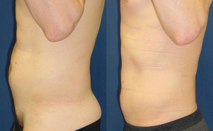 Before and after photo of an actual Liposuction patient.