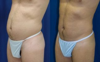 Before and after photo of an actual Liposuction patient.