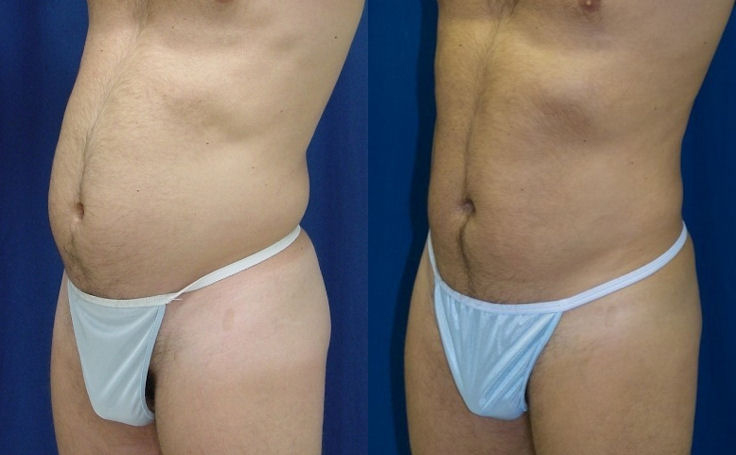 Before and after photo of an actual Liposuction patient.