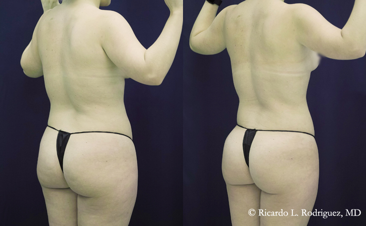 Before and after photo of an actual Liposuction patient.