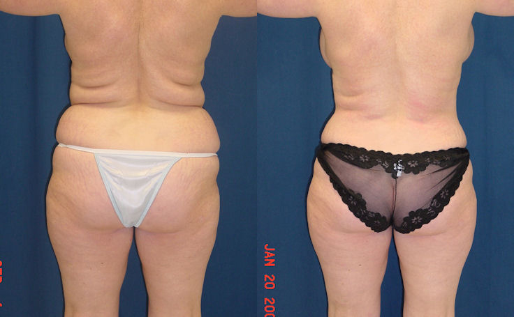 Before and after photo of an actual Liposuction patient.