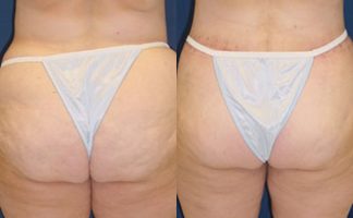 Before and after photo of an actual Liposuction patient.