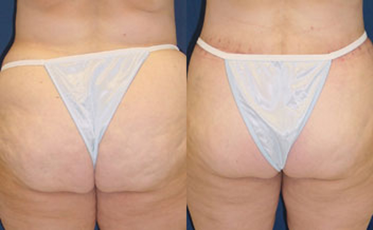 Liposuction - Abdomen / Flanks Before and After Pictures Case 14, Coeur  d'Alene, ID