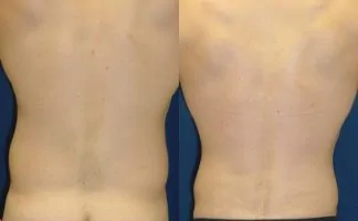 Before and after photo of an actual Liposuction patient.