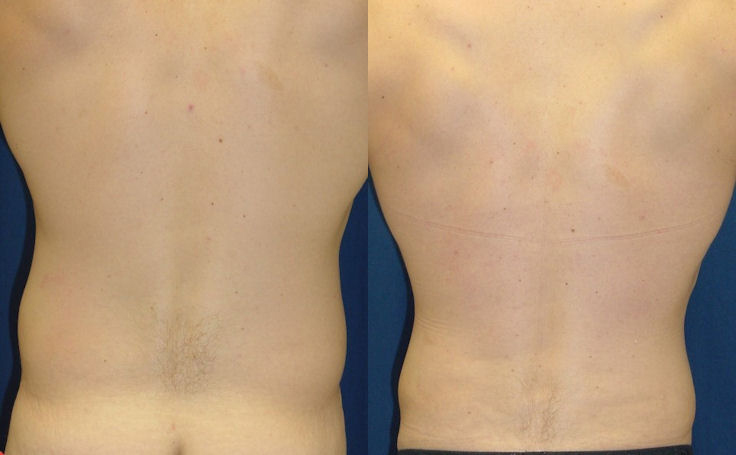 Liposuction of the 'love handles' or flanks