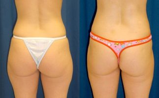 Before and after photo of an actual Liposuction patient.