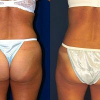 Liposuction - Abdomen / Flanks Before and After Pictures Case 14, Coeur  d'Alene, ID