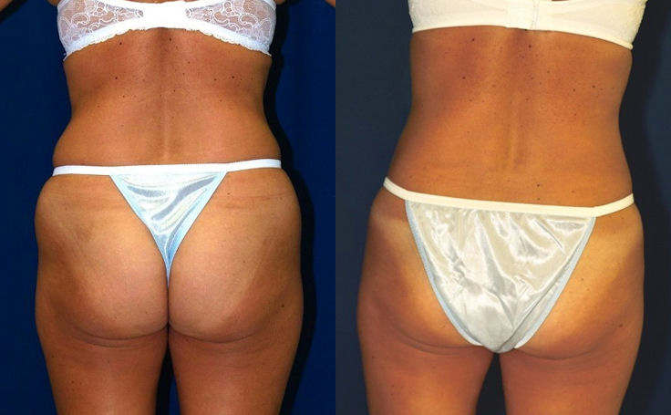 Before and after photo of an actual Liposuction patient.