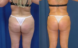Before and after photo of an actual Liposuction patient.
