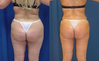 Before and after photo of an actual Liposuction patient.