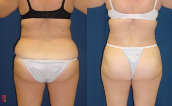 Smartlipo Flanks Liposuction for Women - Before & After Photos