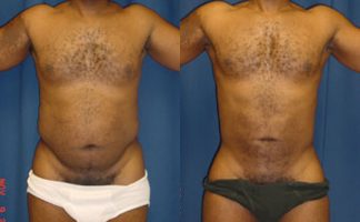 Before & After Lipo of flanks - Dr. Rodriguez, Cosmeticsurg