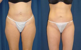 Before and after photo of an actual Liposuction patient.