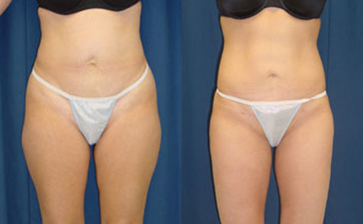 Before and after photo of an actual Liposuction patient. 