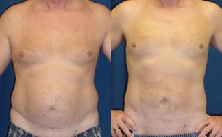 Before & After Lipo of flanks - Dr. Rodriguez, Cosmeticsurg