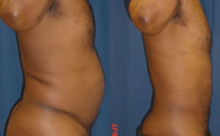 Before and after photo of an actual Liposuction patient.