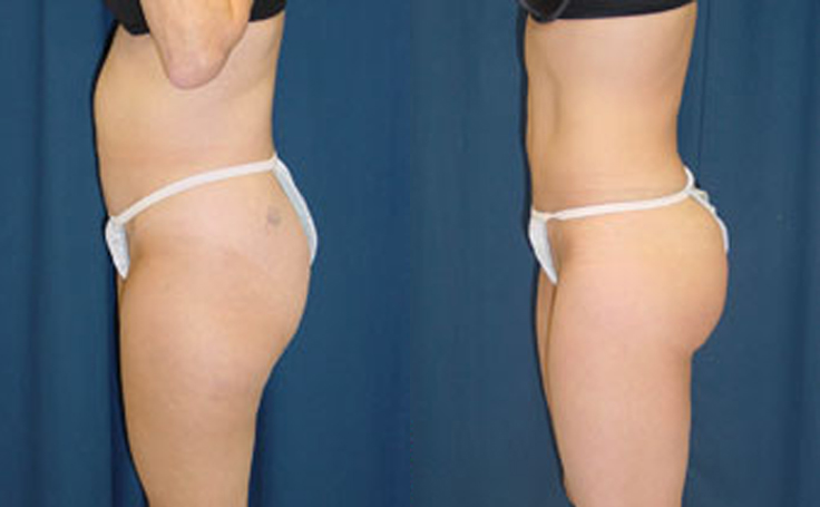 Before and after photo of an actual Liposuction patient.