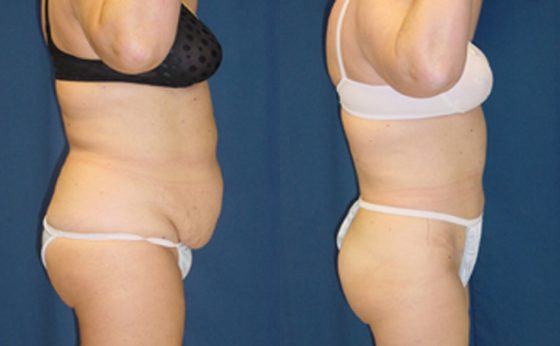 Liposuction of Flanks Before and After 3804