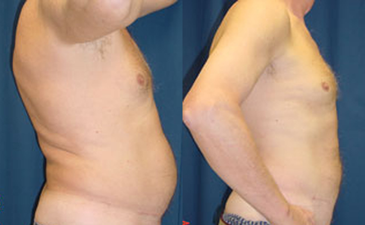 Before and after photo of an actual Liposuction patient.