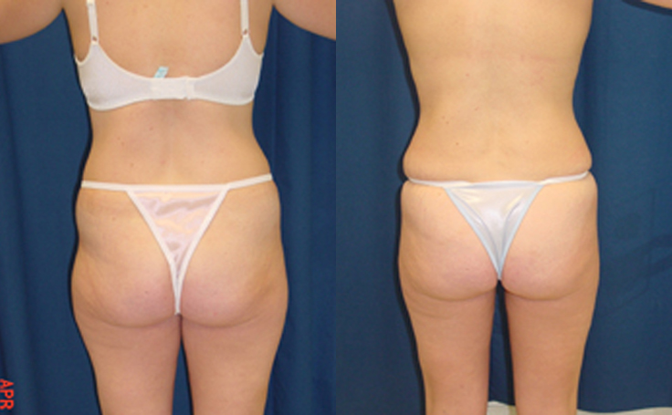 Before and after photo of an actual Liposuction patient.