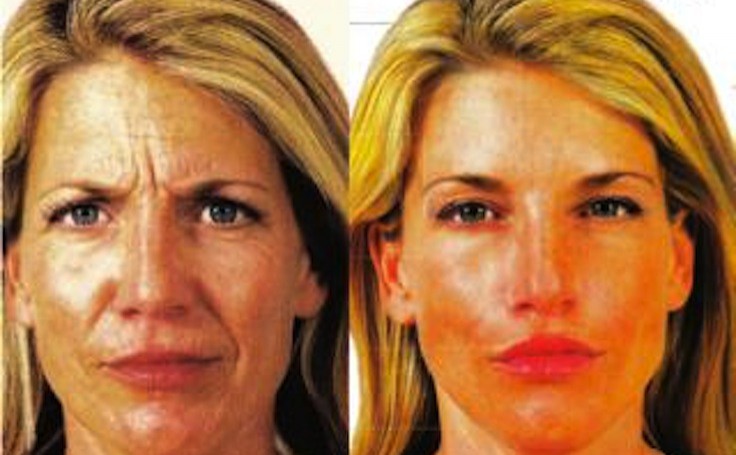 Before and after photo of an actual Facial Fillers patient.