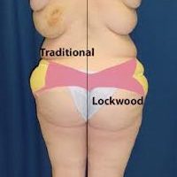 A collage of photos of a patient before & after a Body lift with the Lockwood technique.