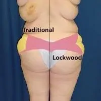 A collage of photos of a patient before & after a Body lift with the Lockwood technique.