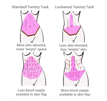 An illustration showing the Tummy tuck Lockwood technique.