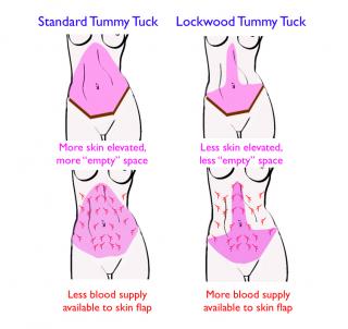 What are the different types of tummy tucks?