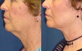 Before and after photo of an actual Facelift patient.