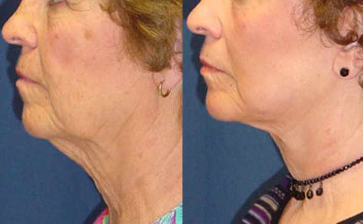 Before and after photo of an actual Facelift patient.