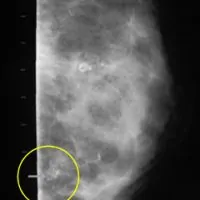 X-ray: Calcification from fat necrosis.