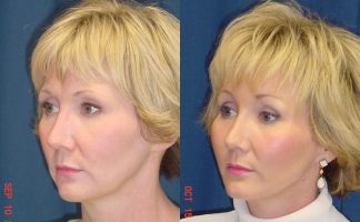 Before and after photo of an actual Facelift patient.