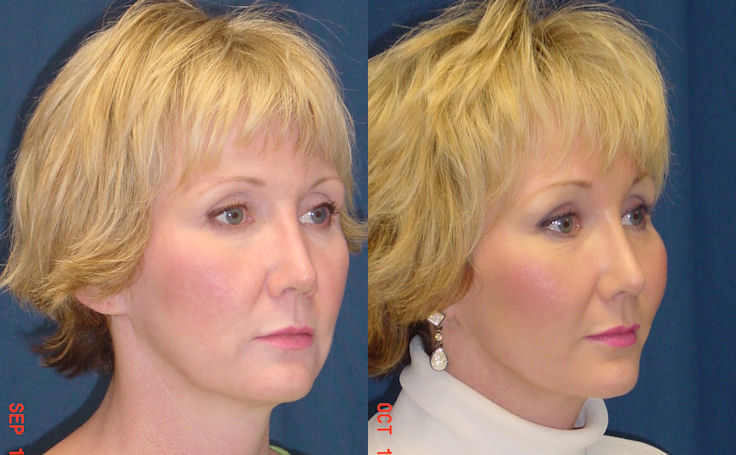Before and after photo of an actual Facelift patient.