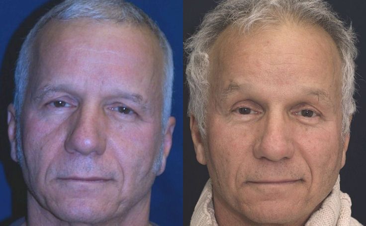 Before and after photo of an actual Facelift patient.