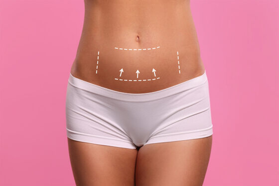 Mini Tummy Tuck | Ricardo L. Rodriguez MD, Baltimore Plastic Surgeon