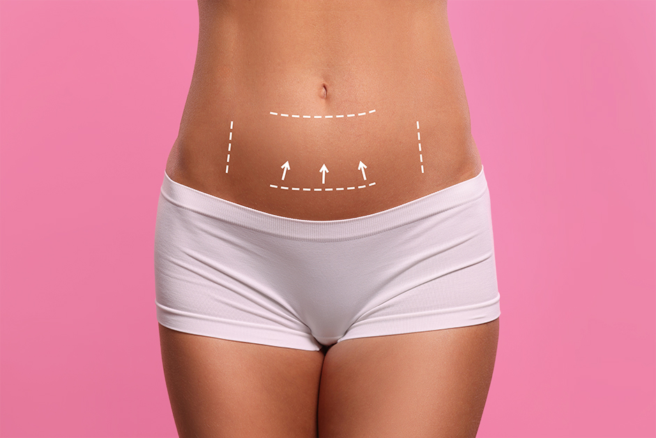 Woman’s lower abdomen with guide marks illustrating the area treated in a mini tummy tuck procedure.