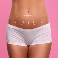 Woman’s lower abdomen with guide marks illustrating the area treated in a mini tummy tuck procedure.