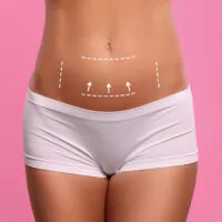 Woman’s lower abdomen with guide marks illustrating the area treated in a mini tummy tuck procedure.