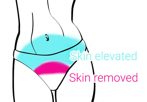 illustration of a mini tummy tuck showing the lower abdominal skin elevated (blue) and a small section of skin removed (pink) just above the pubic area