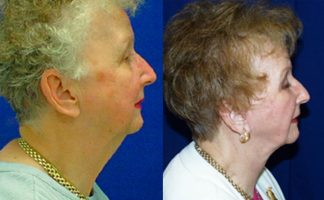 Before and after photo of an actual Neck Lift patient.
