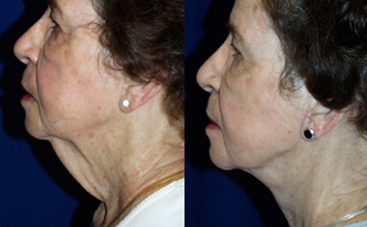 Before and after photo of an actual Neck Lift patient.