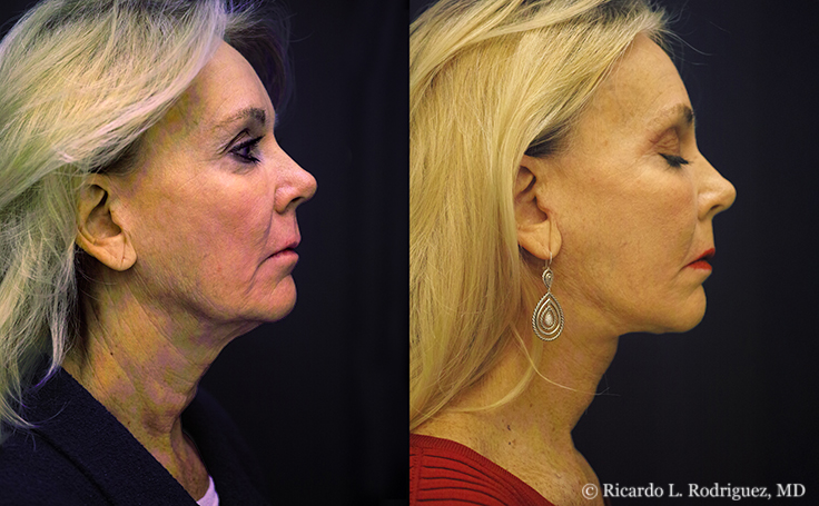 before and after a neck lift