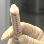 Purified fat sample in syringe.