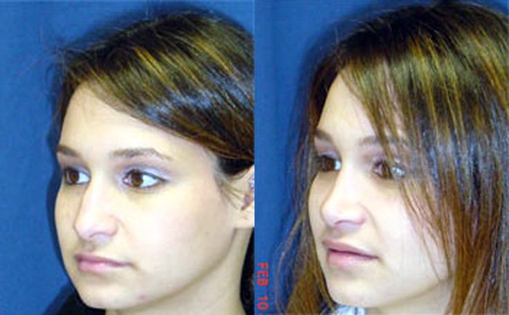 Before and after photo of an actual Rhinoplasty patient.