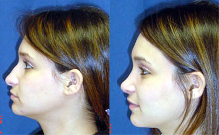 Before and after photo of an actual Rhinoplasty patient.